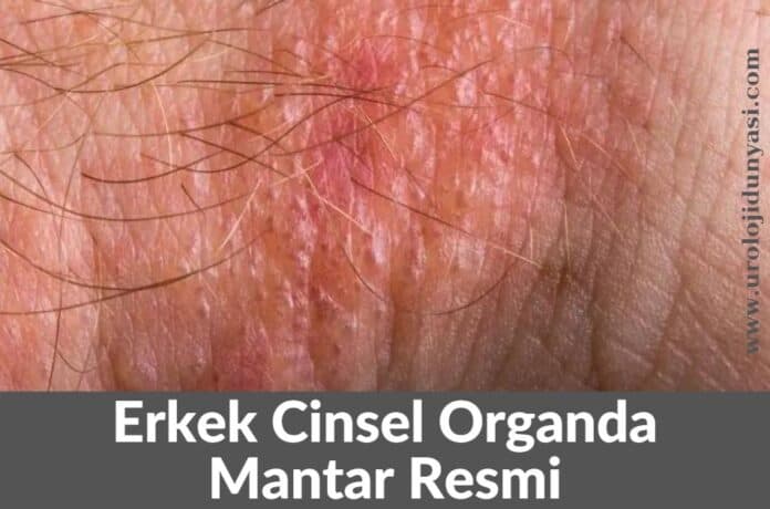 Penis Mantar Nedir Roloji D Nyas