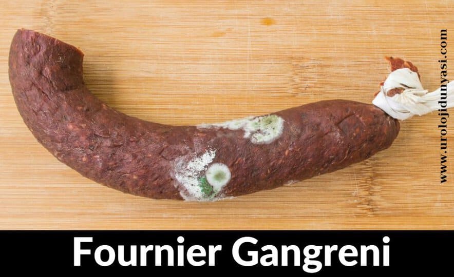 fournier gangrene