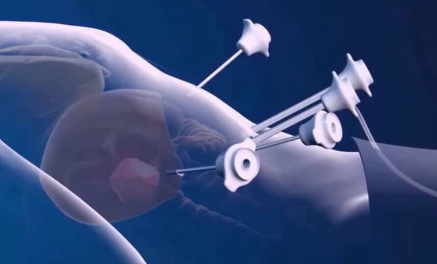laparoskopi ameliyatı