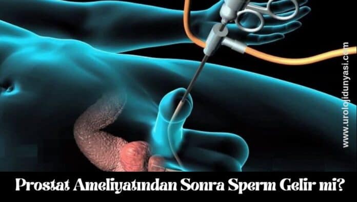 prostat ameliyatından sonra sperm gelir mi