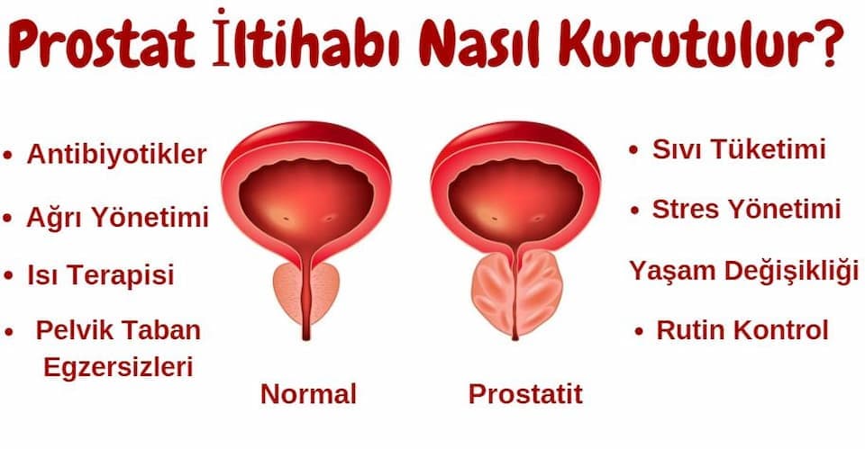prostat iltihabı nasıl kurutulur