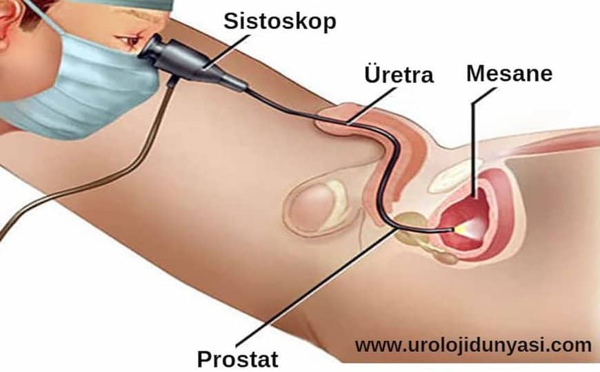 sistoskopi nasıl yapılır